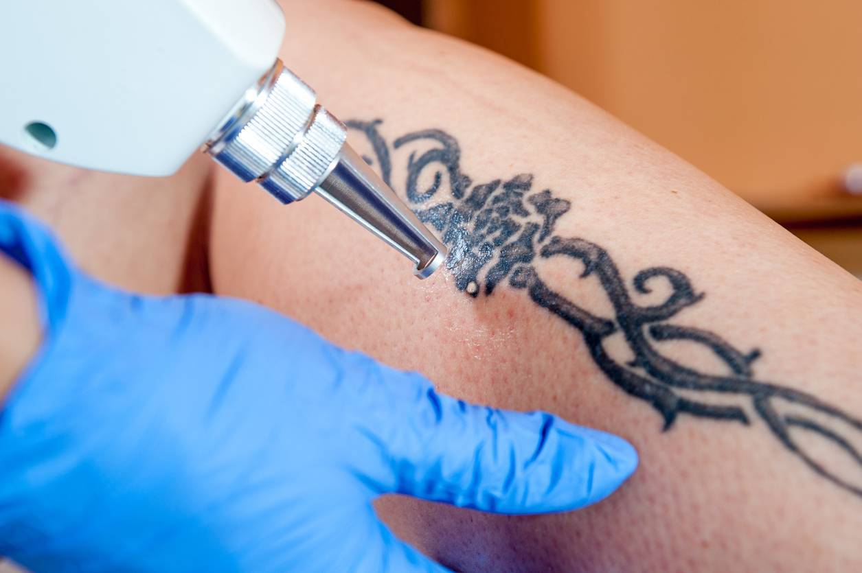 desarrollo sesión eliminación de tatuajes